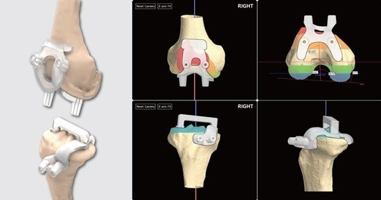 연세사랑병원이 3D·AI 기반의 맞춤형 수술도구 ‘니비게이트(KNEEVIGATE)’와 한국형 인공관절 ‘PNK 인공관절’을 통해 인공관절수술의 정확도와 환자 만족도를 높인다는 계획이다. / 연세사랑병원 제공